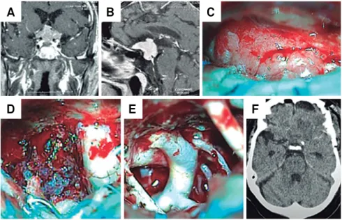 Figure 4. T1-weighted MRI with contrast enhancement in cases of A: small, B: medium, C: large: and D: giant OGMs and TSMs.