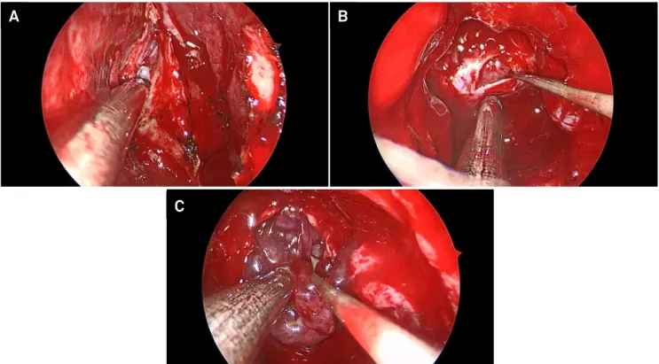 Figure 1. Intraoperative imaging demonstrating the surgical steps involved in the resection of a giant pituitary adenoma