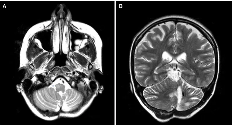 Figure 1. (A) Axial T2-weighted image showing enlargement and hyperintensity of the right olivary nuclei, compatible to hypertrophic  olivary degeneration; (B) Coronal T2-weighted image displaying reduced left cerebellar hemisphere associated to hemosideri