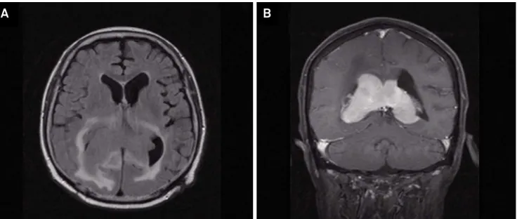 Figure 1. FLAIR sequence (A) showing expansive mass located in the topography of the fornix and splenium of corpus callosum  and  extending to the lateral ventricles