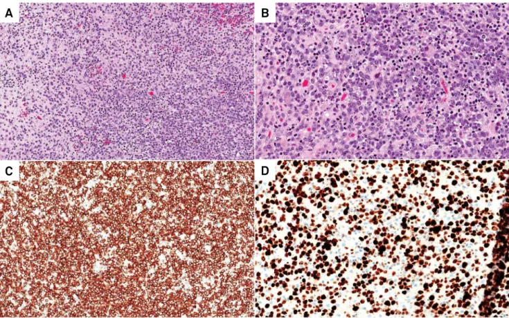 Figure 2. Histologically, the central nervous system parenchyma was diffusely infiltrated by discohesive cells (A, H&amp;E, 100x)