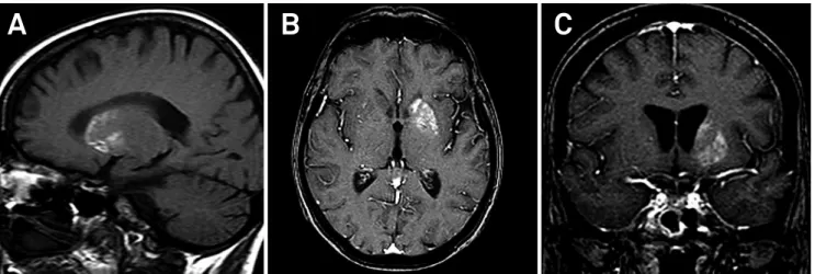 Figure 1.  A) Sagittal T1- weighted magnetic resonance imaging showing spontaneous diffuse high intensity of the left  striatum (caudate nucleus and putamen)