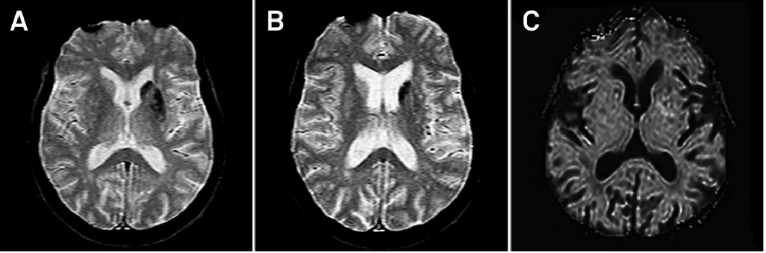 Figure 2. A and B) Axial T2*-weighted gradient-echo MRI showing multiple conluent foci of hypointensities in left striatum  probably due to petechial hemorrhage