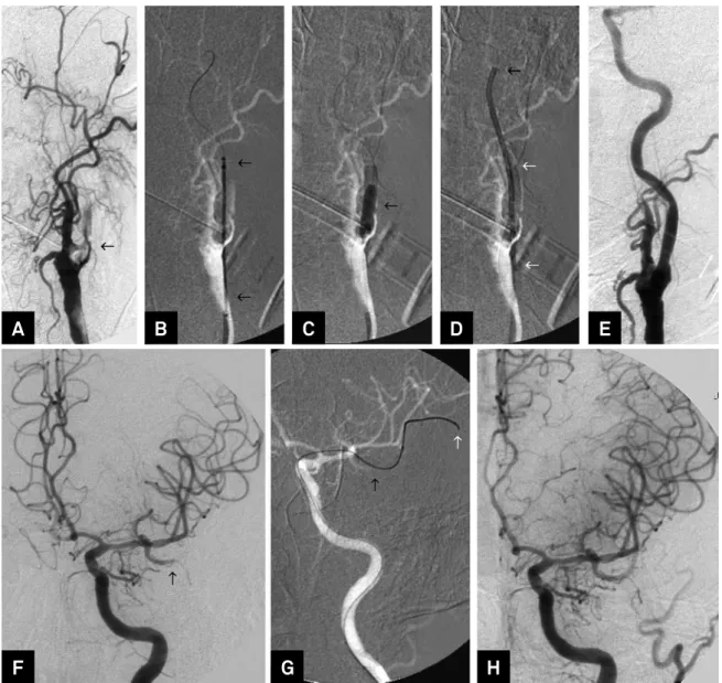 Figure 2. Patient 10. (A) Digital subtraction angiography (DSA) of the left common carotid artery (LCCA) arterial phase, oblique  view, shows a proximal occlusion of the LICA (black arrow)