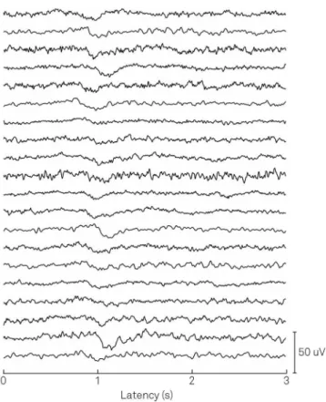 Figure 1. Evoked potentials of the subjects. Evoked potentials  following laser stimulation of the twenty subjects