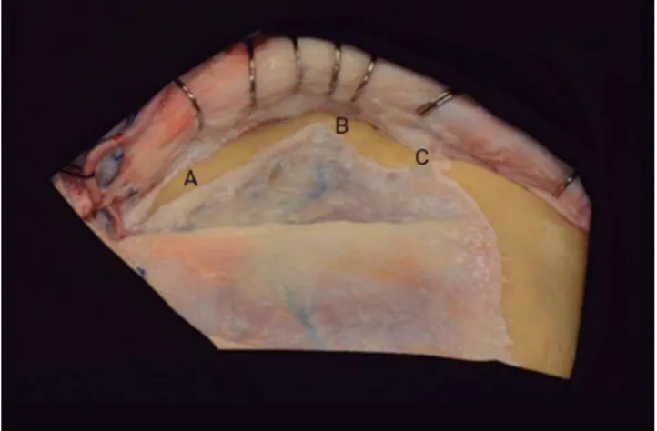 Figure 3. The zygomatic process of the temporal bone (A), the  zygomatic bone with its temporal (B) and frontal process (C).