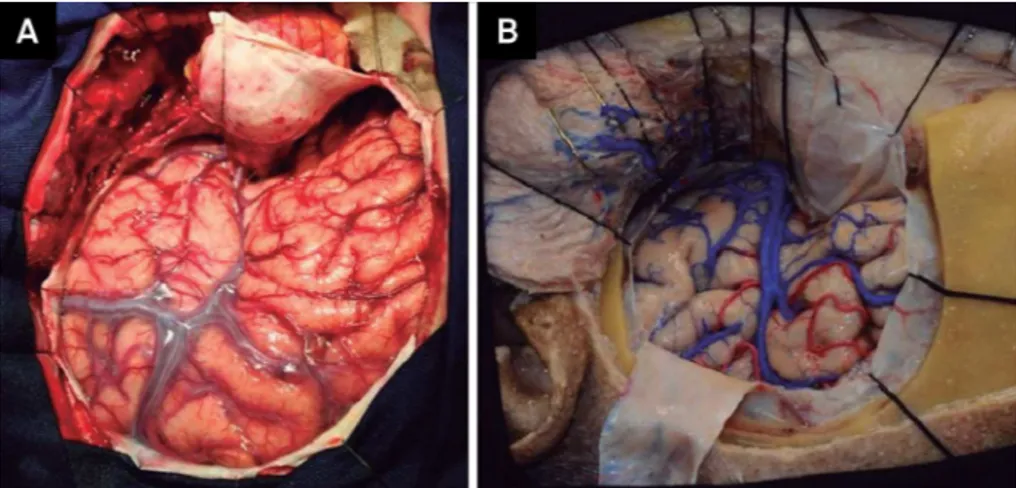 Figure 10. Surgical view (A) and cadaveric specimen (B) showing the dural opening and exposing the lateral fissure, the entire  temporal lobe and the frontal lobe.