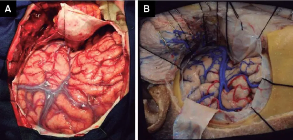 Figure 10. Surgical view (A) and cadaveric specimen (B) showing the dural opening and exposing the lateral fissure, the entire  temporal lobe and the frontal lobe.