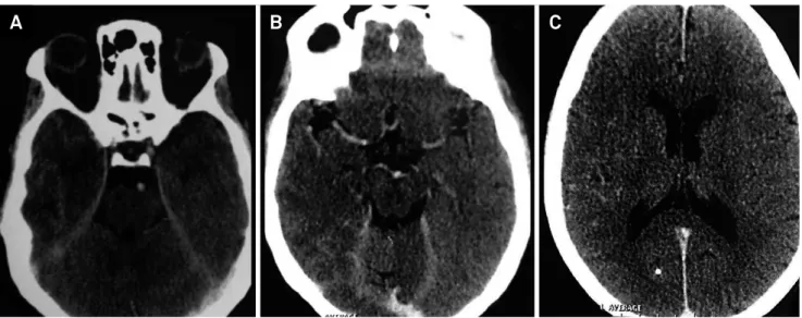 Figure 1. Cranial computed tomography before the patient was admitted to hospital due to non-convulsive status epilepticus  (January 2015)