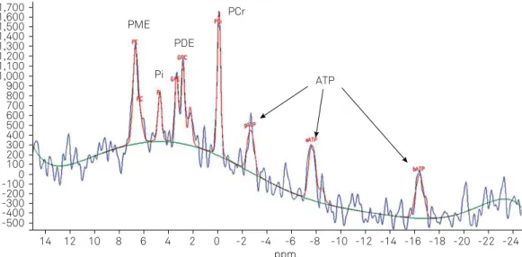 Figure 1. Normal  31 P- MRS: PCr (phosphocreatine ), Pi (inorganic phosphate), g-, a-, b-ATP (adenosine triphosphate) representing  energetic pool