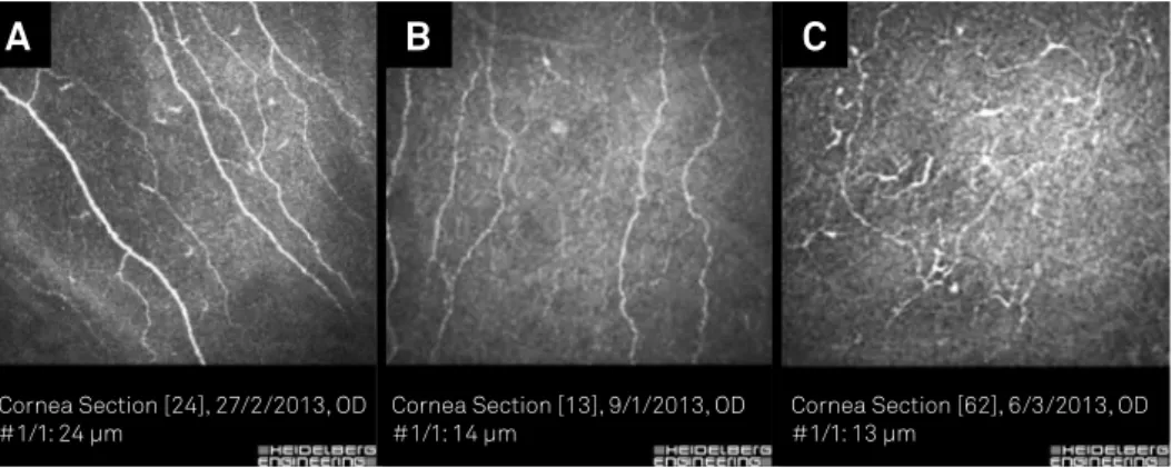 Figure 1. Confocal microscope images of corneas showing (A) thick, parallel ibers; (B) parallel ibers of medium thickness; and (C)  thin non-parallel, unorganized ibers.