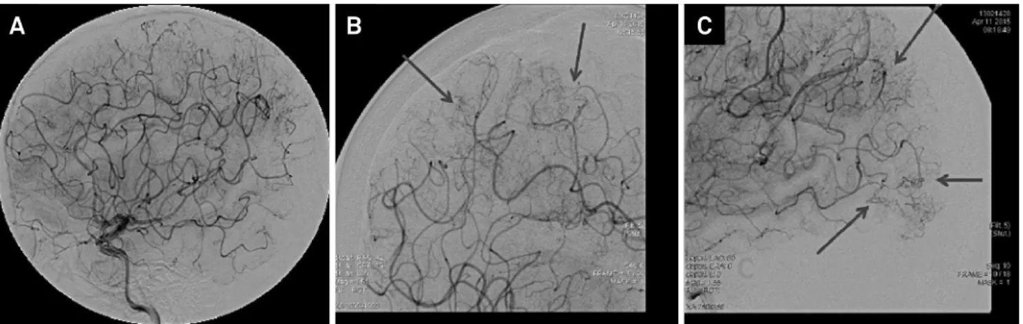 Figure 4. Angiography capillary phase (A, B and C): occlusions of distal vessels + prominent collateral circulation (arrows), best  visualized in the enlarged images (B and C).