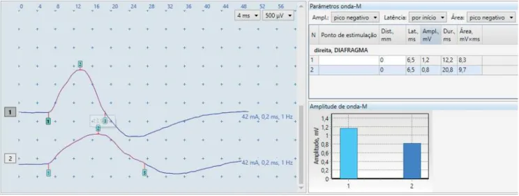 Figure 1. Phrenic inspiratory and expiratory CMAPs.