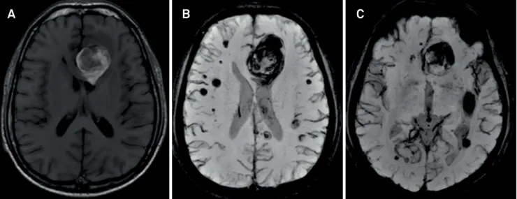 Figure 2. Brain MRI in axial T1 (A), Axial-susceptibility-weighted (B) and multiplanar reconstruction (C) showing an heterogeneous  lesion with a hyperintense signal associated with perilesional vasogenic edema suggestive of acute hematoma
