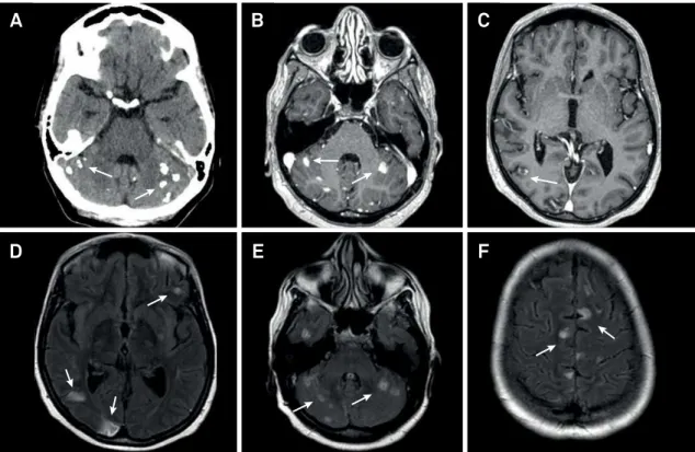 Figure 1. Axial brain CT scan without contrast shows calcification in the cerebellar hemispheres (A)