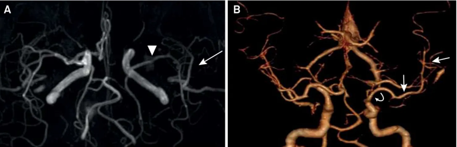 Figure 2. Brain MRI angiography shows segmental narrowing of the left middle cerebral artery (arrowhead) with reduction of flow  in the opercular segments (arrow) (A)
