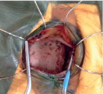 Figure 1. The patient’s head is positioned placing the zygomatic  arch at the highest point, allowing better visualization of the  body and tail of the hippocampus through the surgical corridor  in later steps; skin incision marked (5 cm of extension).