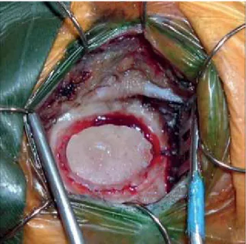 Figure 3. Key-hole craniotomy (2 cm of extension) is centered  at the hippocampal point