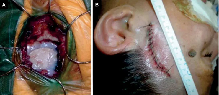 Figure 9. A. The bone lap has been repositioned, ixed with ibrin glue; B. The skin closed with running sutures.