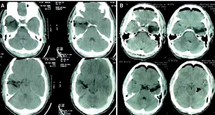 Figure 11. Immediate postoperative head CT, illustrating the mesial structure resection through the minimally-invasive approach.