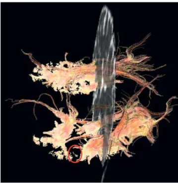 Figure 12. Brain MRI at the two-year follow-up, illustrating  the resection of mesial structures with preservation of  temporal neocortex.
