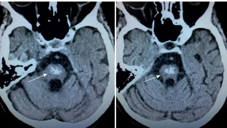 Figure 2. Brain CT performed 15 years after disease onset. Marked pontine calcification, centered on transverse pontocerebellar  fibers and raphe