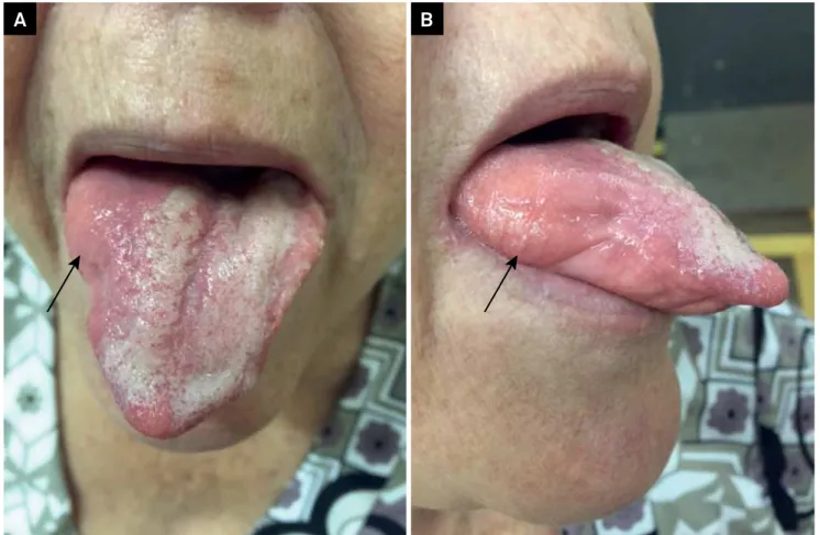 Figure 1. Abnormal tongue morphology in LOPD. (A–B) Diffuse tongue atrophy and abnormal fatty replacement of the tongue  musculature resembling a “tumor-like” structure in the right side of the tongue (white arrow)