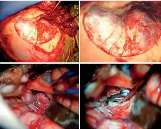 Figure 2. Surgical technique. Above, pretemporal approach. Below, aneurysm dissection and clipping