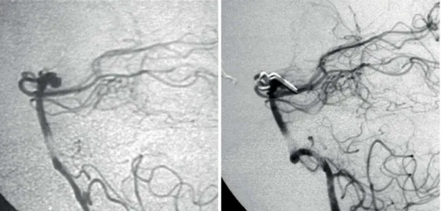 Figure 3. Pre- and postoperative angiography of a patient harboring a BTA with a posterior pattern of position