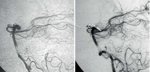 Figure 3. Pre- and postoperative angiography of a patient harboring a BTA with a posterior pattern of position