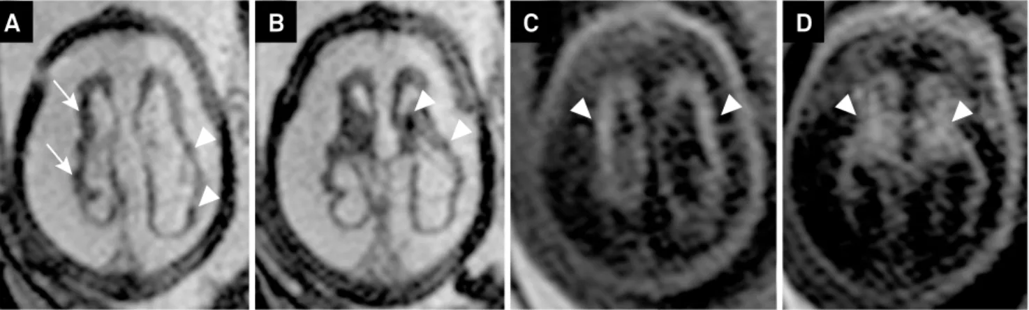 Figure 4. MR images of Patient 8 at 28 weeks of gestation (A and B, T2-weighted single-shot fast spin-echo images on axial  and sagittal planes, C and D, T1-weighted images on axial plane) demonstrating microcephaly and bilateral asymmetrical  ventriculome