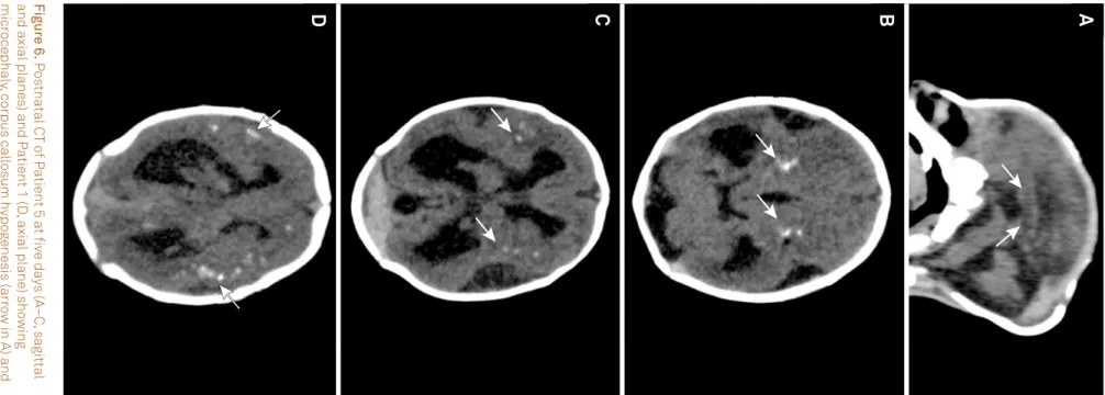 Fig ur e 6.  P os tna tal C T  o f P a tient 5 a t iv e da ys (A –C , sagittal and axial planes) and Patient 1 (D, axial plane) showing microcephaly, corpus callosum hypogenesis (arrow in A) and the distribution of calciications, which are predominantl y i