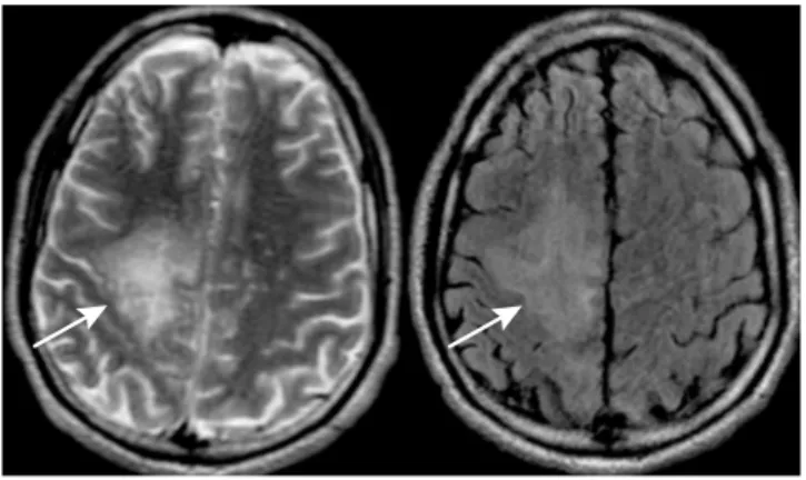 Figure 1. Brain MRI discloses subcortical lesions (hyperintense  signal) with cortical preservation in a patient with JC virus infection.