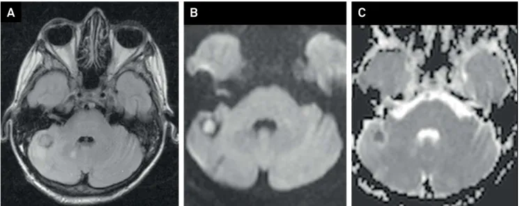Figure 4. Brain abscess caused by Aspergillus involving the cerebellum in a transplant recipient
