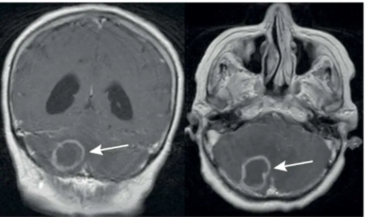 Figure 6. Brain MRI shows an expansive lesion with gadolinium  enhancement in the cerebellum