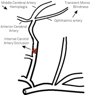 Figure 3. Schematic igure of the site of the internal carotid  artery occlusion in Fisher’s irst patient with transient  monocular blindness associated with hemiplegia.