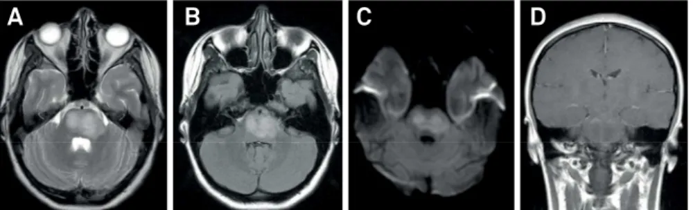 Figure 2. Brain MRI after treatment. Axial T2 weighted (A), FLAIR (B) and DWI (C) sequences demonstrate almost complete resolution  of the brainstem lesion
