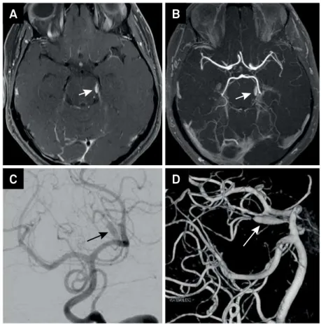 Figure 1. Axial post-contrast brain MRI (vessel wall imaging) shows abnormal asymmetric vessel wall enhancement in left  superior cerebellar artery (A); axial 3D-TOF MRI angiography shows segmental ectasia in the left superior cerebellar artery (B)