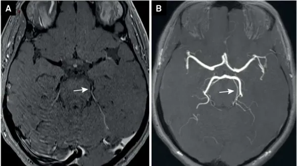 Figure 2. Six-month follow-up. Axial post-contrast brain MRI (vessel wall imaging) shows no enhancement in left superior  cerebellar artery (A); axial 3D-TOF MRI angiography shows no artery aneurysm (B).