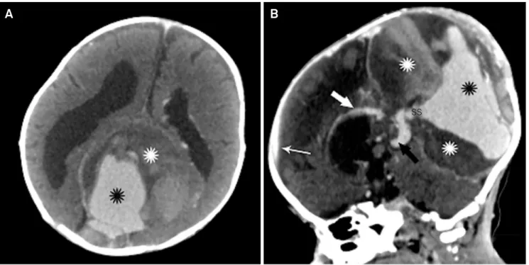 Figure 2. Axial (A) and sagittal (B) contrast enhanced CT angiography showing the extension of thrombosis (white asterisks) and  the mass effect in the posterior sagittal sinus malformation (black asterisks)