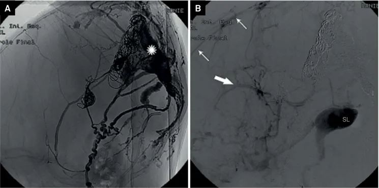 Figure 4. Lateral view final cast (A) of combining arterial and venous with liquid embolic and coil embolization filling the superior  sagittal sinus malformation (white asterisk) and late phase of internal carotid digital angiography (B) after the endovas