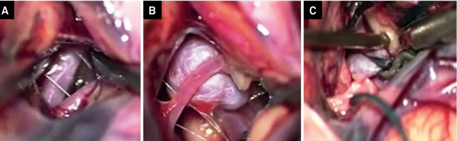 Figure 2. Intra-operative vision and clipping of middle cerebral artery aneurysms. 