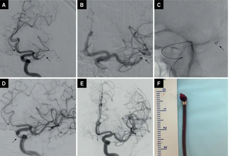 Figure 2. (A) Digital subtraction angiography (DSA) of LICA, oblique view, shows an occlusion of the distal M1 segment of the   left middle cerebral artery (MCA) (arrow); (B) distal tip of the 5MAX-ACE is engaged in the thrombus (arrow); (C) distal tip of 