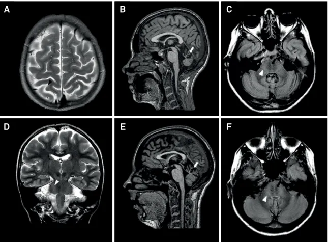 Figure 2. Brain MRI of ARSACS patients. Brain MRI of patient 1 (A-D) and patient 2 (E-F)