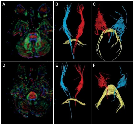 Figure 4. Diffusion tensor imaging tractography in ARSACS. Fractional anisotropy images show the difference between a healthy  individual (A-C) and patient 2 with  ARSACS (D-F)