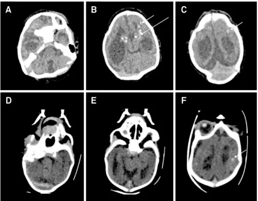 Figure 1. A, B and C are brain computerized tomography from Patient 1 and D, E and F are from Patient 2