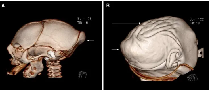 Figure 2. A and B show the computed tomography of the skull with reconstruction, of Patient 1, with the typical phenotype of fetal  brain disruption sequence characterized by microcephaly with exuberant occipital protuberance (short arrow) and redundant sk