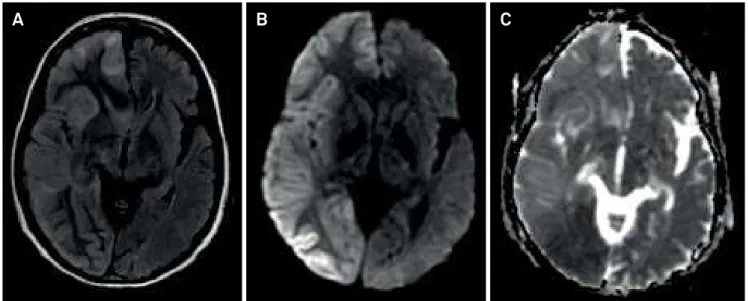 Figure 1. Brain MRI during epilepsia partialis continua. FLAIR (A) image: right hemispheric increased signal intensity and swelling  at the cortical gray matter and subcortical white matter and mild midline shift