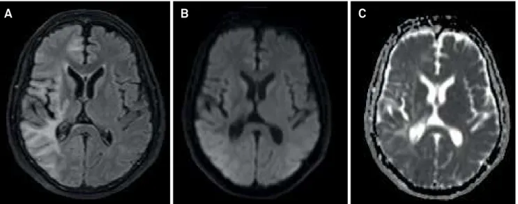 Figure 2. Brain MRI two weeks after resolution of the  epilepsia partialis continua with antiepileptic drugs