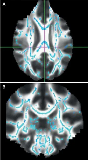 Figure 1. DTI showed diffuse damage of the white matter in  patients with ALS.
